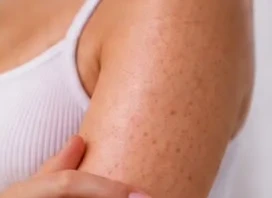 Xie Smooth Skin tratamiento para queratosis pilaris piel de gallina
